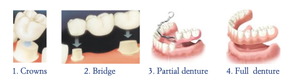 Crown, Bridge, denture picture