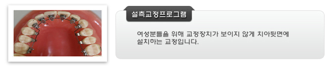 설측교정 프로그램은 여성분들을 위해 교정장치가 보이지 않게 치아뒷면에 설치하는 교정입니다.
