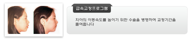 급속교정프로그램은 치아의 이동속도를 높이기 위한 수술을 병행하여 교정기간을 줄여줍니다.