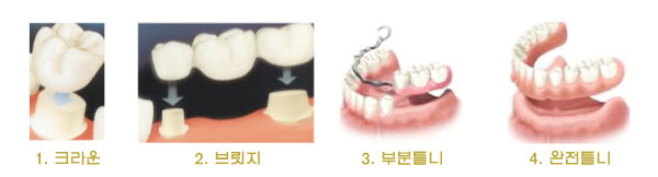 1.  크라운	2.  브릿지 3. 부분틀니 4.  완전틀니 참고사진