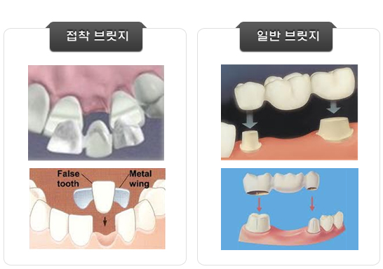 접착 브릿지와 일반 브릿지 사진